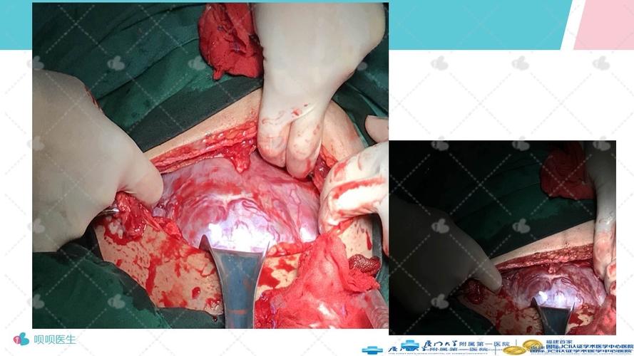 宫颈提拉式缝合