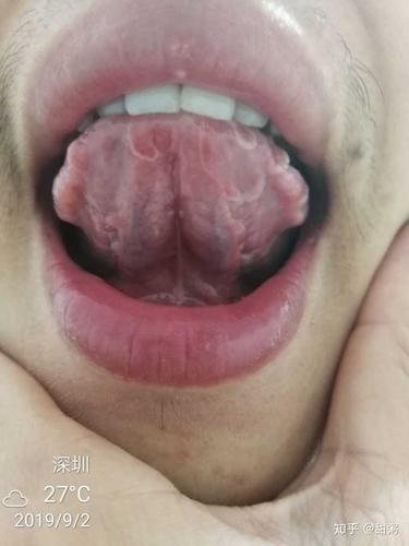 想请教这能估算出是哪种原因导致的裂纹舌吗?