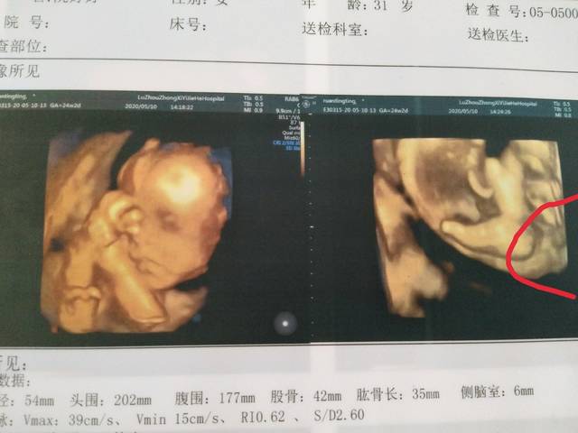 24周做的四维彩超 画圈圈的是不是小蛋蛋