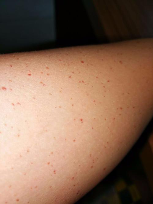 两个手胳膊上全是红点是什么原因
