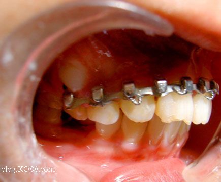 方丝弓技术在替牙期恒前牙外伤固定中的应用