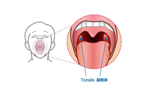 腺样体肥大和扁桃体肥大的区别