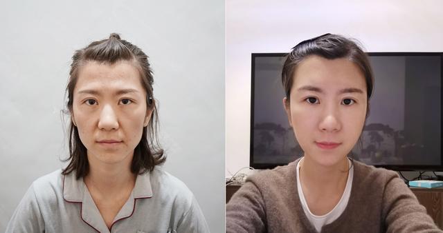 面部脂肪填充,从凹陷干瘪的脸恢复到元气满满,术后2个
