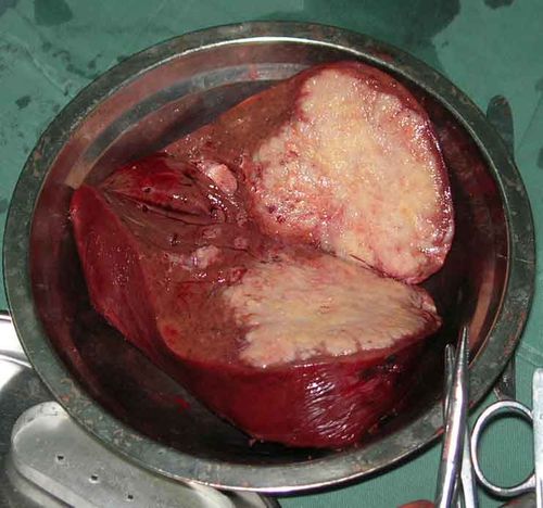 病人为原发性肝癌患者,约37岁.