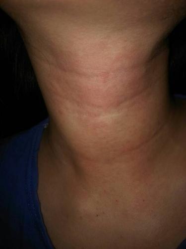 应该是局部过敏,不知道原因,会不会是因为之前感冒的时候我抹了风油精