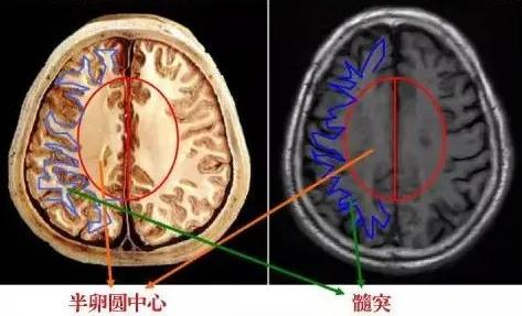 切面上,左右两侧合起来呈卵圆形,而单侧为半卵圆形,故称为半卵圆中心