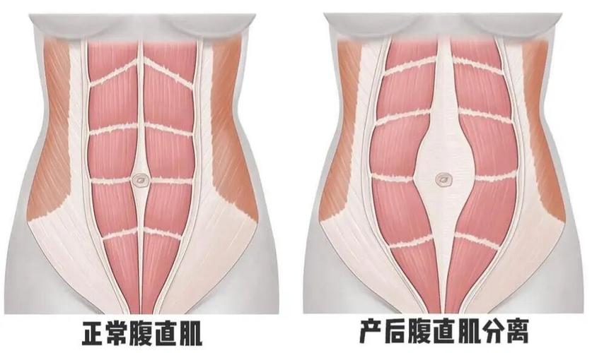 产后腹直肌分离|大肚腩并非都是脂肪7171_腹直肌分离_腹肌_妊娠