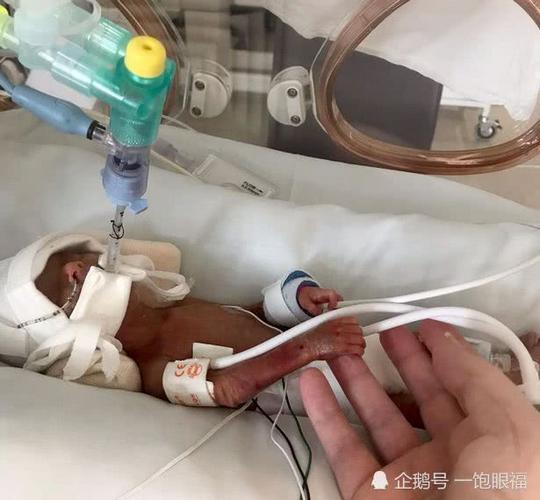 孕妇怀孕24周就生产 双胞胎中的姐姐困在产道中救了妹妹的命