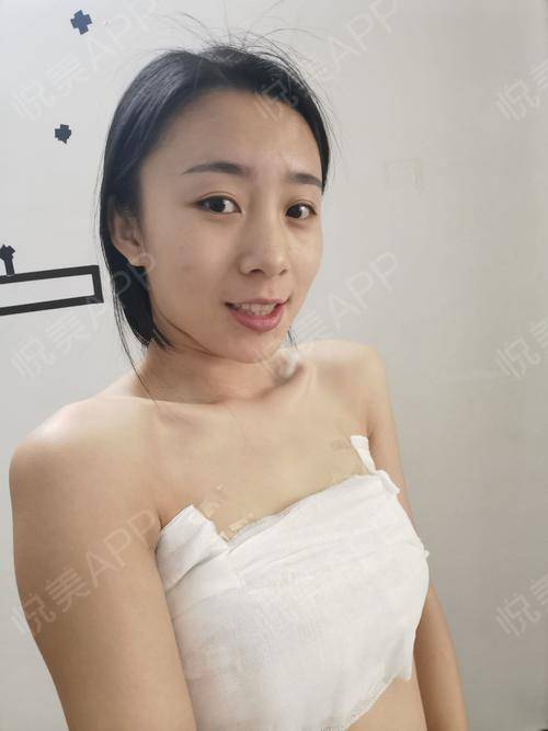 假体隆胸术后7天_隆胸术后7天_胸部整形术后7天_五行缺钱分享图片1