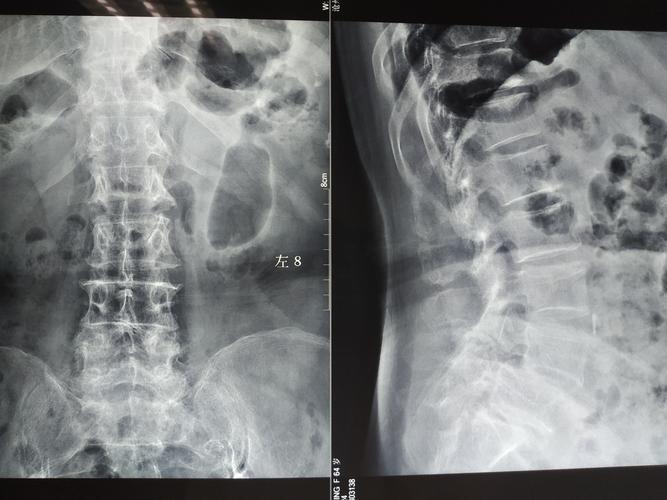 骨三脊柱科腰椎滑脱病例分享