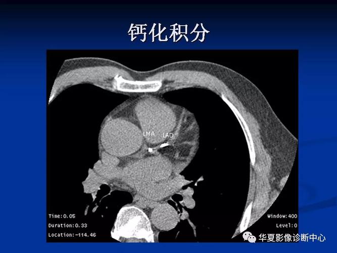 详细解读冠状动脉及冠心病ct