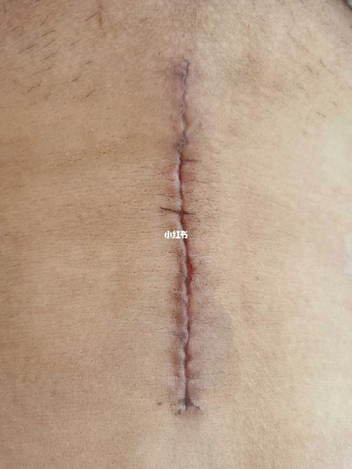 剖腹产竖切祛疤,其实并不难_剖腹产_祛疤_凝胶_疤痕_怀孕_顺产_棉签