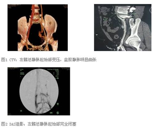浅谈髂静脉压迫综合征