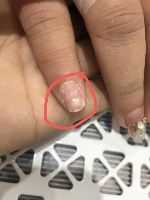 做指甲真菌感染_美甲分享_美妆_美甲