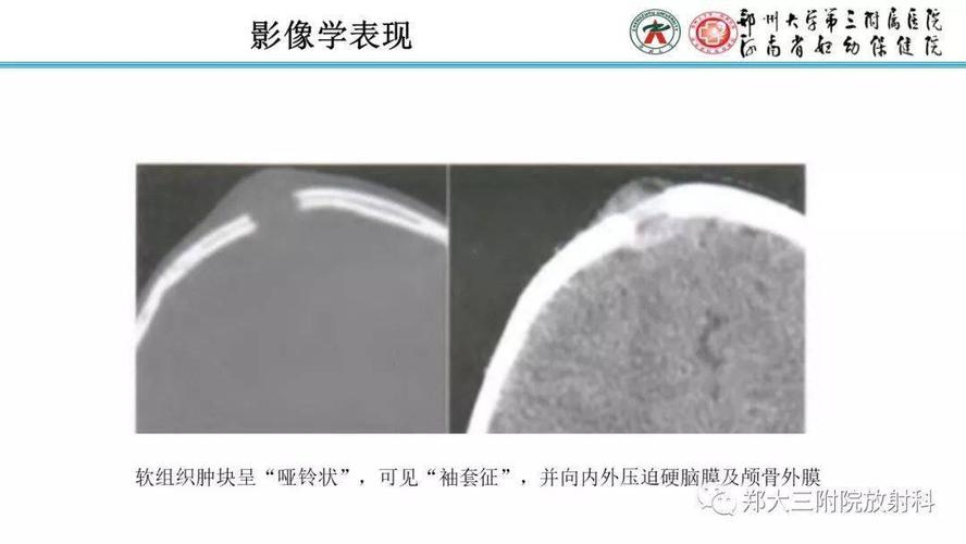 颅骨嗜酸性肉芽肿的病例分析