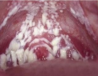 霉菌性阴炎症状图,霉菌性阴道炎也叫阴道念珠菌感染.