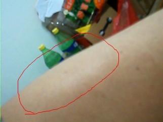 我是学校田径队,发现大腿肿痛,一查是乳酸堆积,怎么办