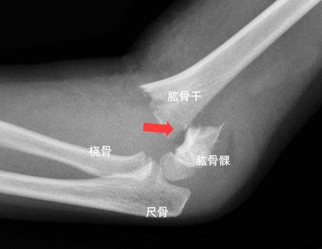 肱骨近折端向前下移位,远折端向上移位,为伸直型肱骨髁上骨折表现.
