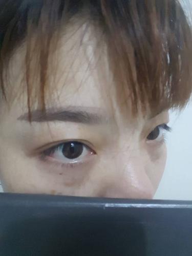 眼睛下面刚开始是黑眼圈,15年开左右发现有很多斑了,是什么原因啊?