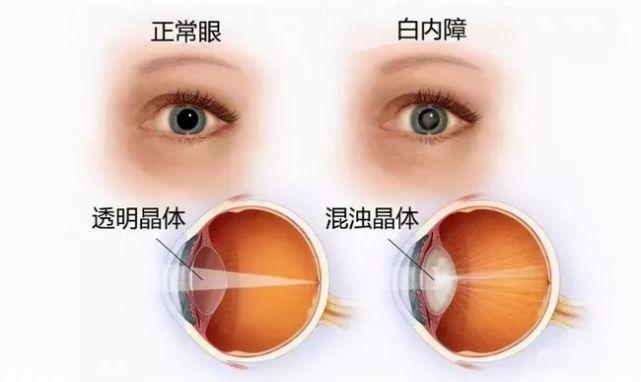 关于白内障这些知识你需要知道
