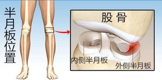 半月板损伤的症状