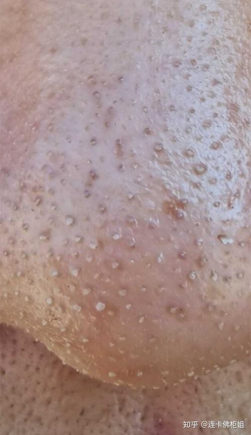 有没有哪个小姐妹给我推荐一下有效去黑头的产品呀,还有一些很小颗的