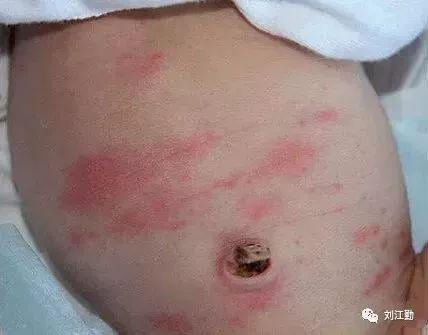 新生儿毒性红斑