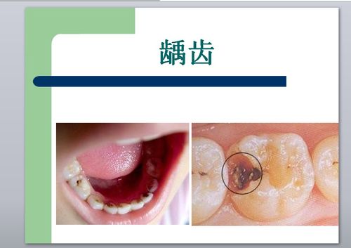 龋齿简介ppt模板下载