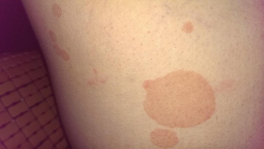 问:皮肤局部出现圆形红色块~不痛不痒~摸起来滑滑的~没有任何不适