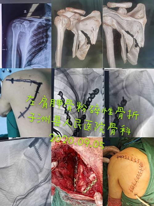 子洲县人民医院骨科自主开展首例肩胛骨粉碎性骨折切开复位内固定手术