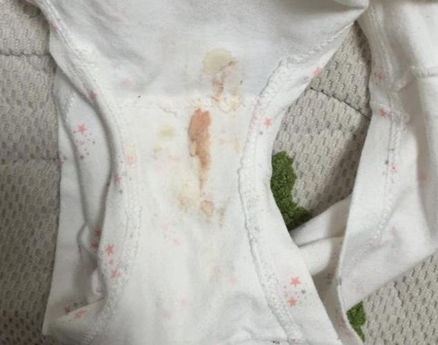 底裤出现2个"特殊颜色",或是宫颈癌在"提醒",劝你早查