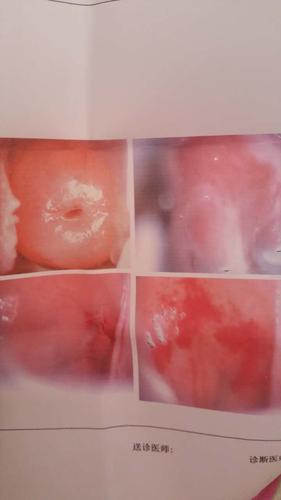 从图片看我想知道有没有宫颈糜烂现象
