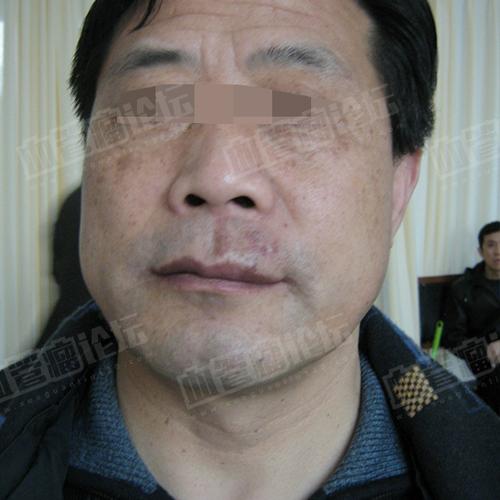 来自高旭成人唇部混合型血管瘤患者日记