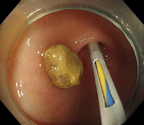 阑尾炎的无创治疗——阑尾炎治疗新纪元