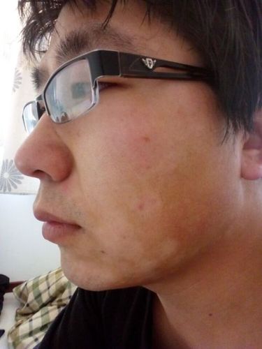 我的脸是不是有癣颜色不一样 有白的有黑的