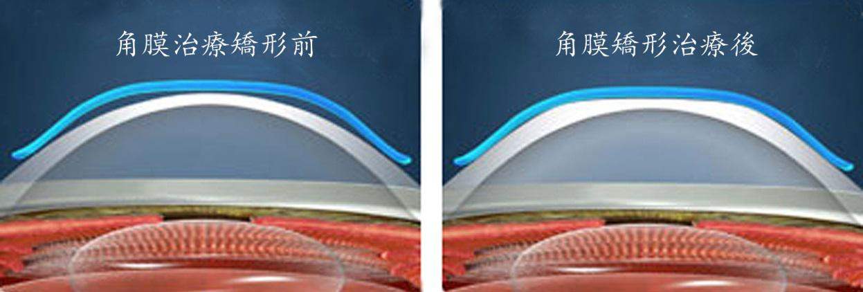 角膜塑形镜是什么?有什么用?