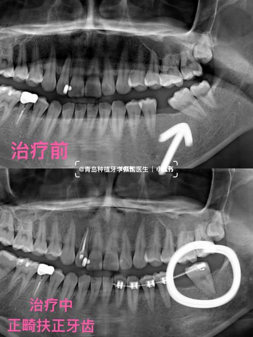 0mmx10mm植体_正畸_发炎_种植牙