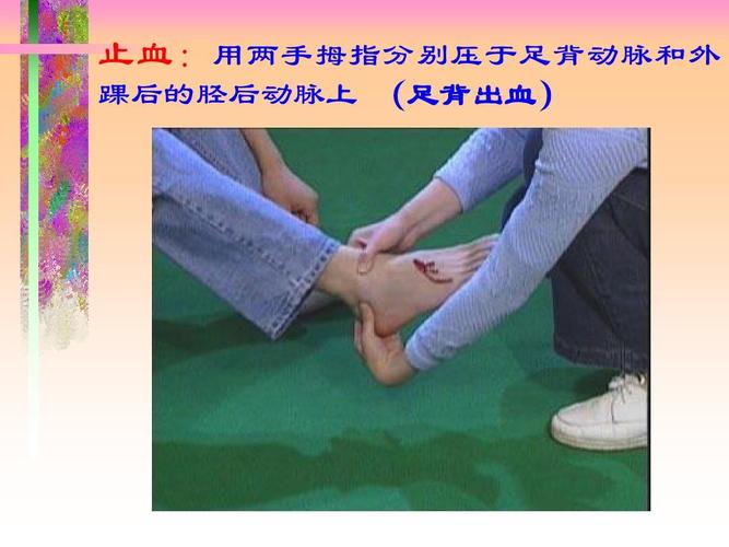 止血: 用两手拇指分别压于足背动脉和外 踝后的胫后动脉上 (足背出血)