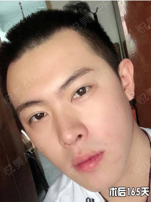 男生做了双眼皮简直帅炸了