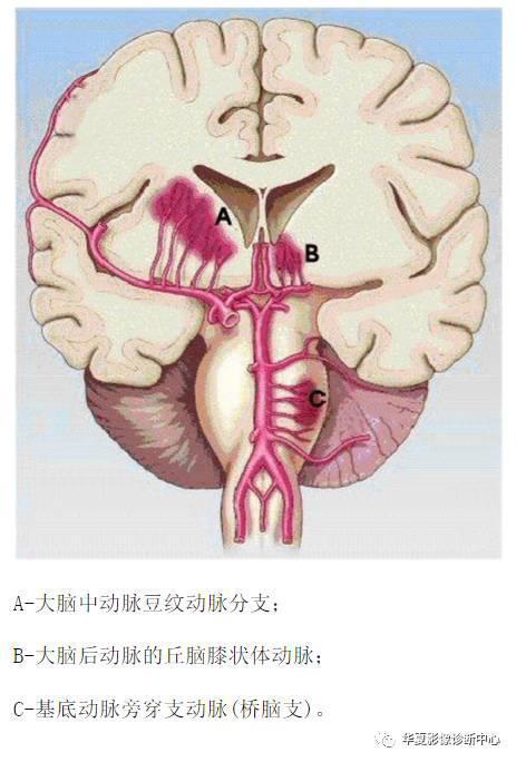 mr脑白质区内斑点影腔梗脱髓鞘缺血灶应如何书写影像报告