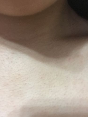 脖子以下胸以上皮肤毛孔粗大 是不是鸡皮肤啊 这样子穿衣服都不好穿很