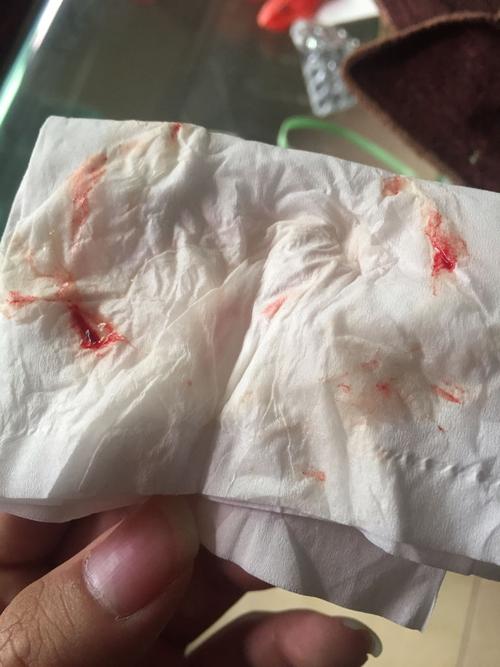 有时鼻涕会带有血,百度一问都是说什么鼻咽癌吓死我了