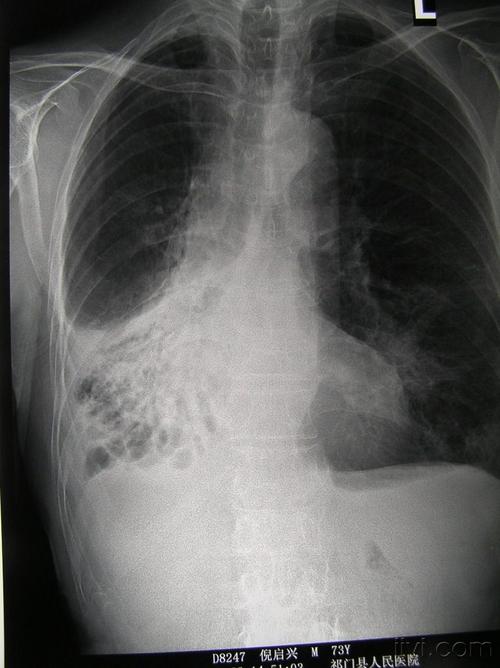 003号《有奖比赛》右下肺阴影的诊断?