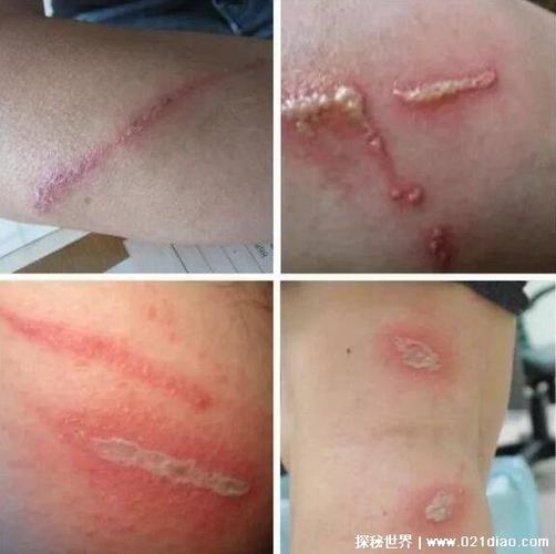 隐翅虫咬人后图片治疗方法隐翅虫留下的疤是永久的吗