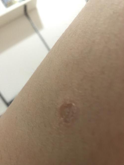 养猫之后 我好像得了猫藓 腿上一个快好了 胳膊上又涨