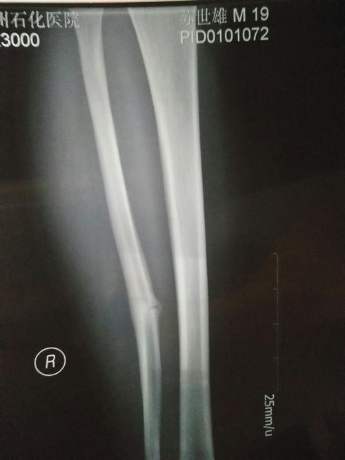 右腿腓骨骨折,恢复期运动不当再次将伤口崩开,现在活动时扔有感觉,想