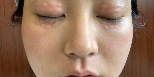 眼周细纹?眼周手针了解一下|鱼尾纹|皱纹_网易订阅