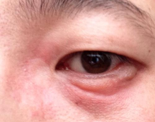 滴了滴左氧氟沙星眼药水,还不见好.是过敏吗?   