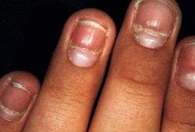指甲在医生眼里,它还能成为人体健康的缩影,手指甲长这样,多半是身体