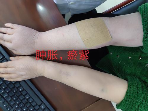 肾病科再次在dsa下球囊扩张处理肿胀手1例